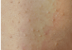 Ingrown hair beneath the skin, missing spots and unsuccessful hair removal make the skin bumpy