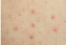 Reddish swelling around the pores