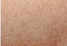 Skin can redden after procedure