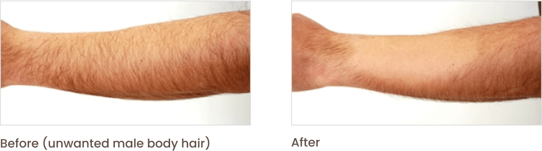 Before (unwanted male body hair) - After